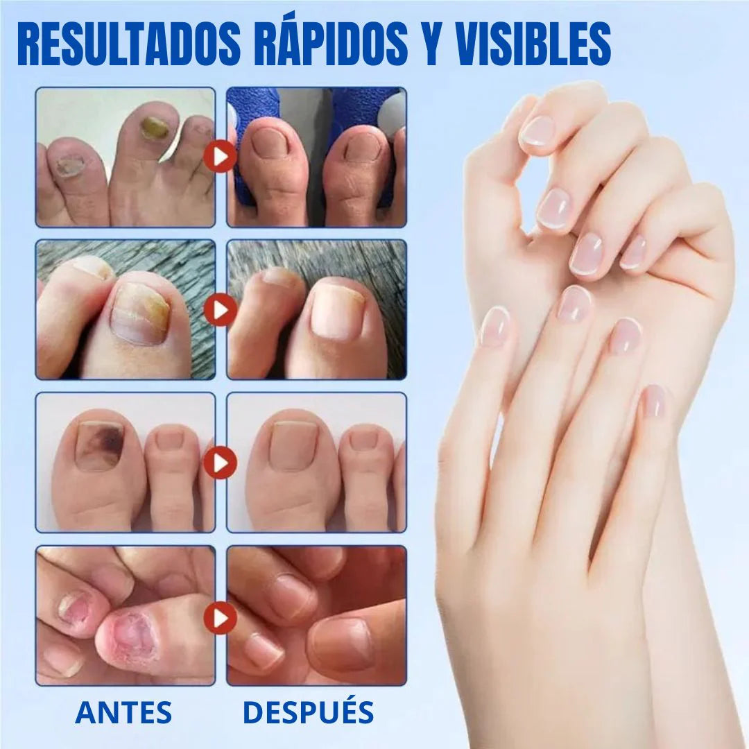 PARCHE UÑAS ANTIHONGOS