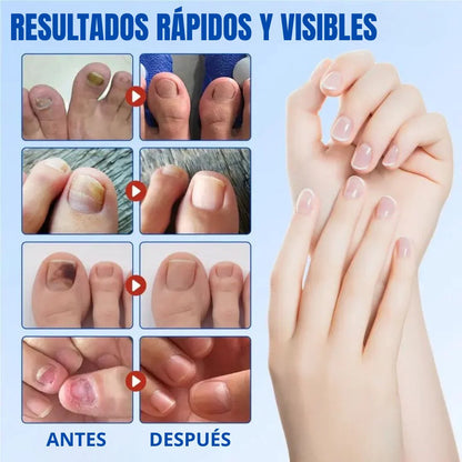 PARCHE UÑAS ANTIHONGOS